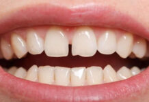 The gap between your teeth tells these special things about you